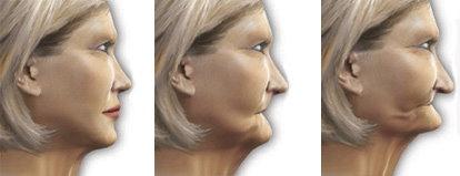 Key Considerations when Treating a Collapsed Jaw